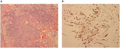 Case Report: Kaposiform Hemangioendothelioma With Spinal Involvement